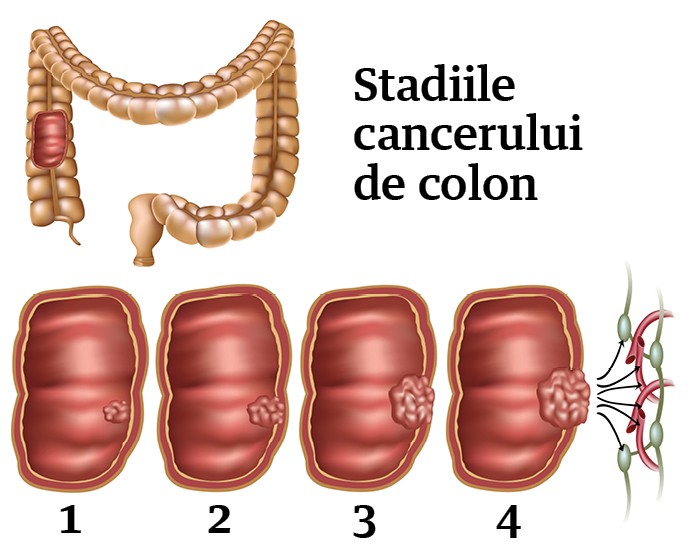 Stadiile cancerului de colon